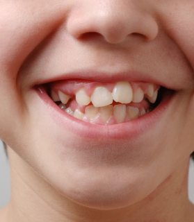Before traditional braces treatment