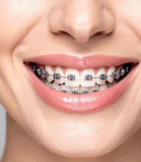 After traditional braces treatment