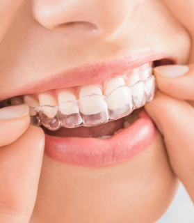 After Invisalign treatment
